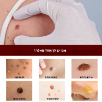 תכשיר להסרת שומות וסרחי עור- 5 DAYS