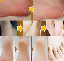 HEEL BALM - משחה טיפולית לעור יבש, קשה וסדוק בכף הרגל