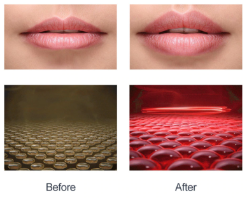 מכשיר LED מהפכני לעיבוי שפתיים – L.lips