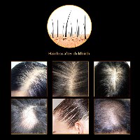 ספריי טיפולי לצמיחת שיער והפסקת נשירה