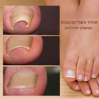 מדבקות לטיפול בציפורן חודרנית - MagicPatch