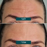 מארז 16 מדבקות סיליקון אנטי-אייג'ינג PDRN זרע סלמון לטשטוש קמטים מבית NightRepair