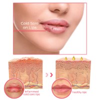 שמן שפתיים לטיפול בפצעי חום וקור