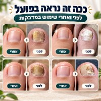 מדבקות הידרוג'ל לטיפול בפטרת ציפורניים ומגוון בעיות ציפורניים של חברת ELAIMEI