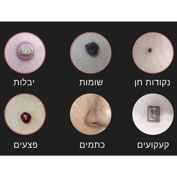 מכשיר-הסרת-קעוקעים