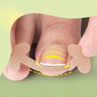 מארז מדבקות למניעת ציפורן חודרנית הגרסה המקורית – ToeRelief
