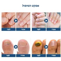 Magic stickers-מדבקות ג'ל לטיפול בפטרת