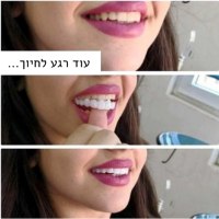 ציפוי-חיפוי-שיניים-לבנות