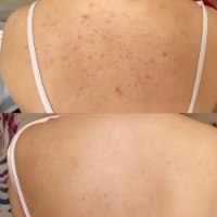 תרסיס פילינג גוף מתקדם Medicube Acne Melting Shot לחיסול פצעונים, הבהרת כתמים והחלקת עור מחוספס