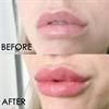 LIP PLUMP SOS סרום לניפוח שפתיים - תוצאה מיידית