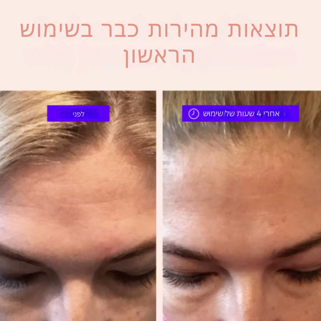 אפקט מתיחה מיידי לעור הפנים