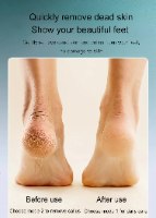 FeetFresh - טיפול אפקטיבי בכפות רגליים יבשות