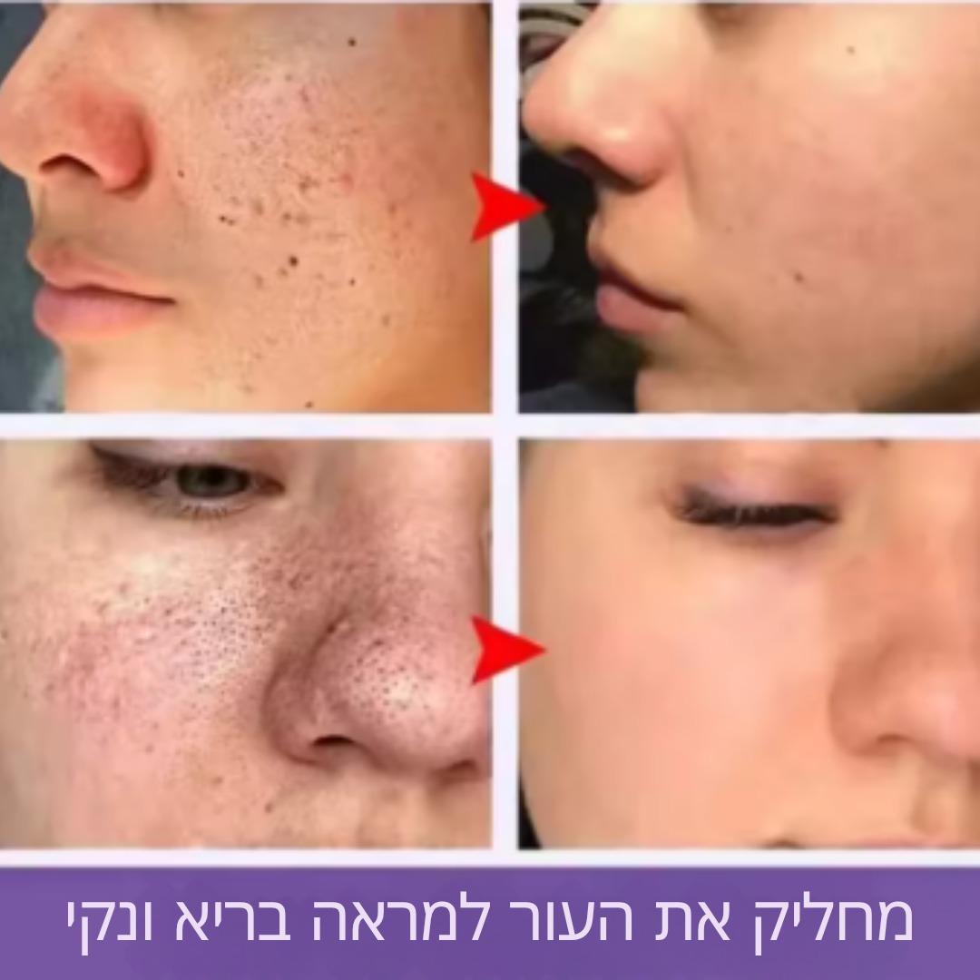 תוצאות הסרום HOYGI - עור חלק עם נקבוביות קטנות