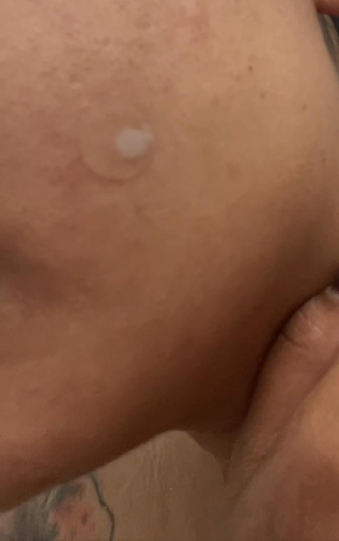 חוות דעת - מדבקות לטיפול ממוקד בפצעים - 360 ACNE
