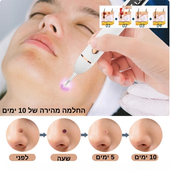 יבלות-עור-פנים