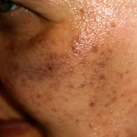 קרם הבהרה לטיפול בפיגמנטציה ופגמי העור