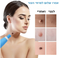 sefudun - ערכת הסרת סרחי עור שומות ופלולות אוטומטית
