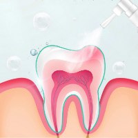 ספריי SOS להקלה על כאבי שיניים
