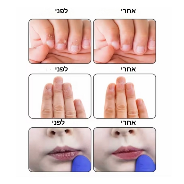 ערכת-תכשירים-לגמילה-מכסיסת-ואכילת-ציפורניים-ציפורן