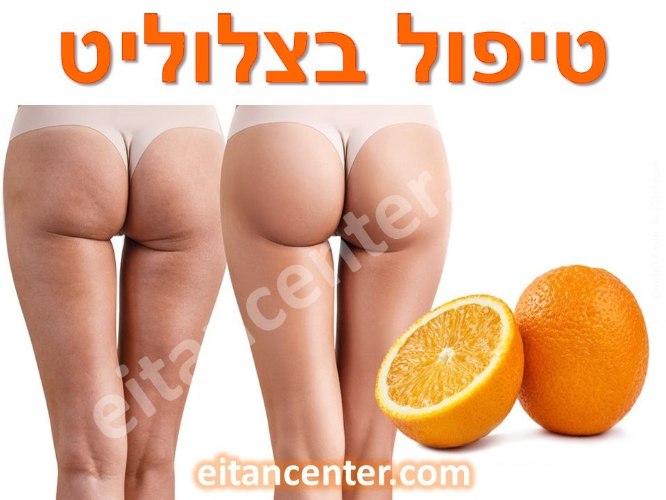 קורס טיפול בצלוליט