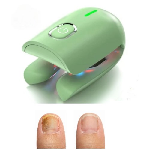 מכשיר לייזר לטיפול בפטרת ציפורניים