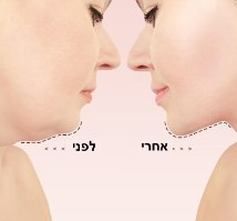רצועת מתיחה לעיצוב ופיסול הסנטר וקו הלסת V-Look