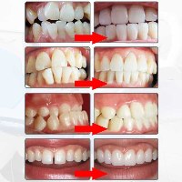 פלטות ליישור שיניים 4D