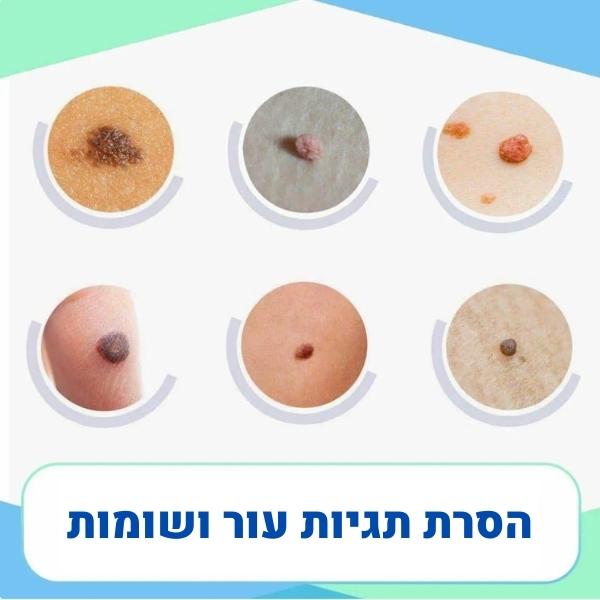 עט-ג׳ל-להסרת-שומות