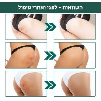 קרם לטיפול באקנה בגוף BodyClear