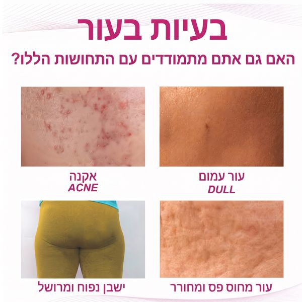 קרם-טיפול-אקנה-פצעונים-פצעוני-ישבן-ירך-נשים