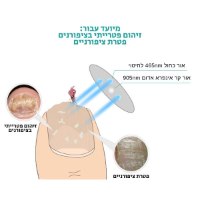 מכשיר-לייזר-ביתי-לטיפול-בפטרת-ציפורניים-יתרונות