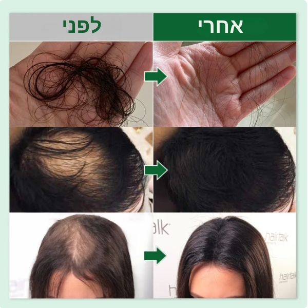 נשירה-התקרחות-שיער