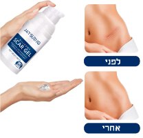 ג'ל להעלמת צלקות בעור