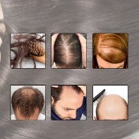 ערכת טיפול טבעית לעידוד צמיחת שיער ומניעת נשירה הכוללת שמן רוזמרין ורולר מיקרו מחטים מבית EELHOE