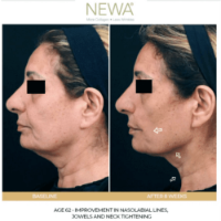 מכשיר NEWA מיצוק עור הפנים החלקת קמטים גלי רדיו הצרת עור הפנים באישור משרד הבריאות