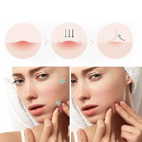 מדבקות לטיפול נקודתי בפצעונים ClearSkin