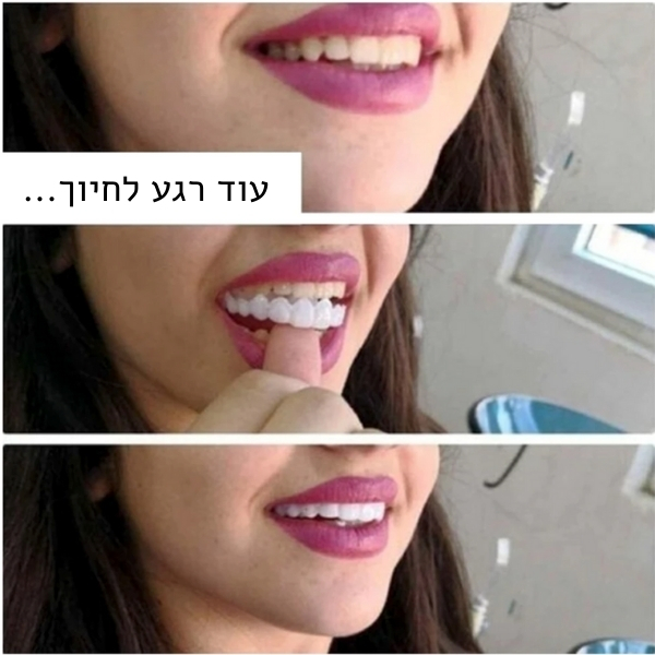 חיפוי-שיניים-וחניכיים