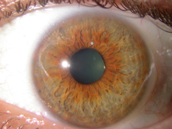 קורס אבחון אירידולוגי - בקשתית העין