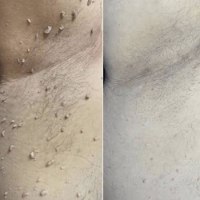 תכשיר רול-און מתקדם להסרת יבלות וסרחי עור מבית ClearTouch