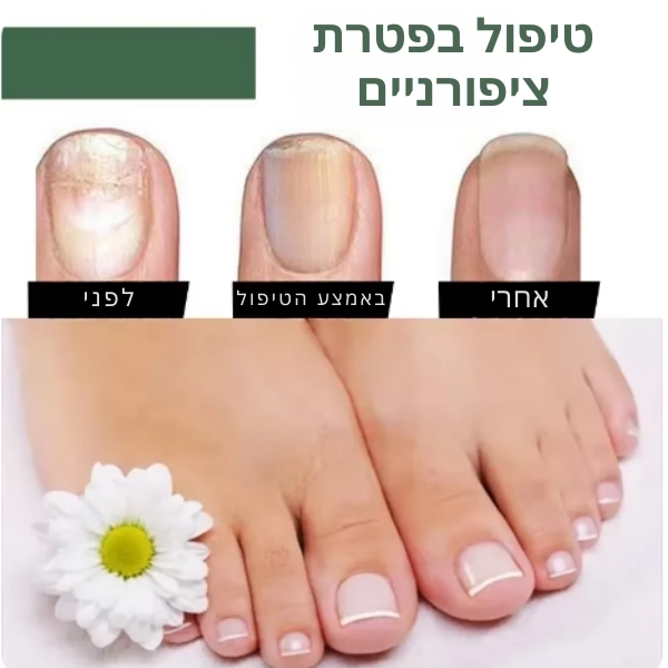 לק-טיפולי-פטרת