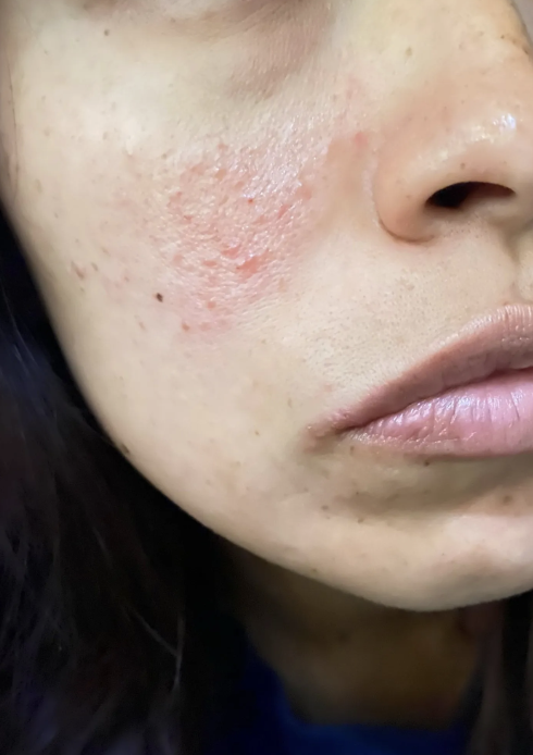 חוות דעת - משחה לטיפול באקנה - ערכת יום ולילה ANTI-ACNE