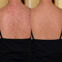 תרסיס פילינג גוף מתקדם Medicube Acne Melting Shot לחיסול פצעונים, הבהרת כתמים והחלקת עור מחוספס