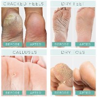 קרם רגליים טיפולי לעור יבש וסדוק
