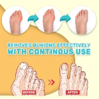 משחה טיפולית ליישור עצם בולטת בכף הרגל- FlexToe