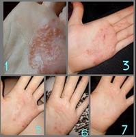 משחה טבעית לטיפול בפסוריאזיס, אסטמת עור, אקנה, סבוריאה, אקזמה,הרפס ופטרת העור - Zudaifu