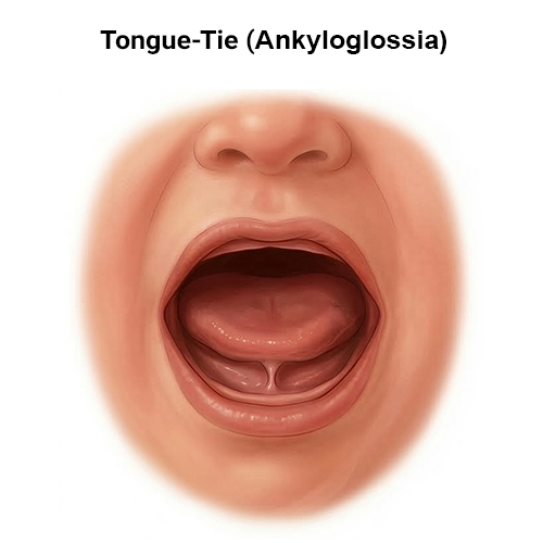 Ankyloglossia tongue tie