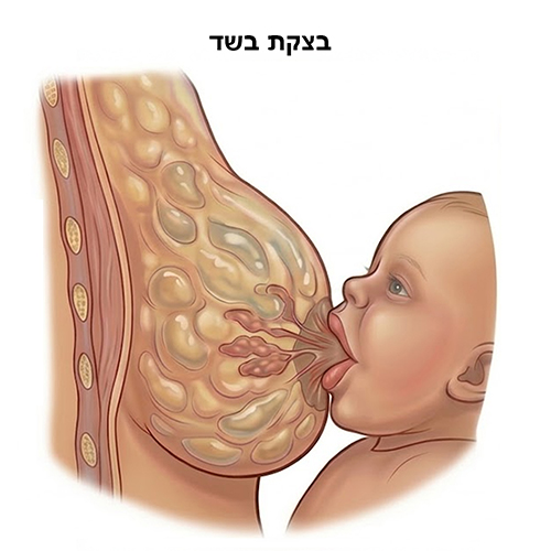 בצקת בשד