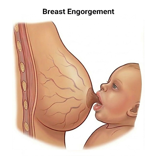 Breast Engorgement