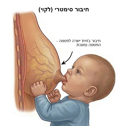 חיבור סימטרי (לקוי) בהנקה