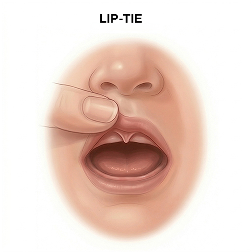 Lip Tie